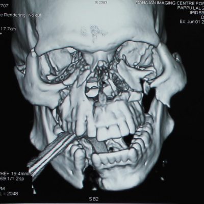 1a-panfacial