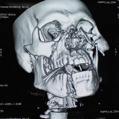 1b-panfacial