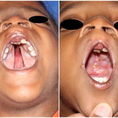 Cleft palate 2