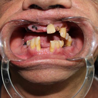 hybrid-denture-1