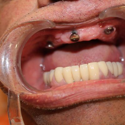 hybrid-denture-2