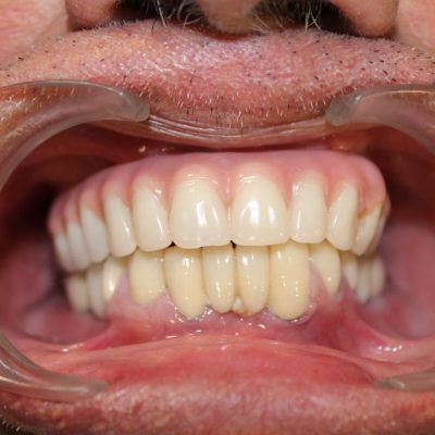 hybrid-denture-3