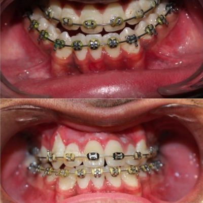 maxillary-surgery-2