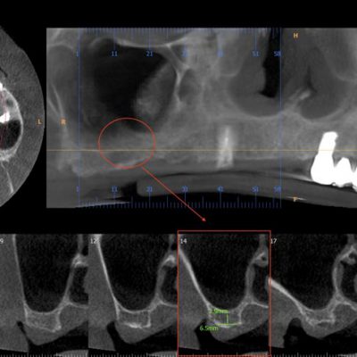 right-maxilla-cross-sections