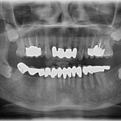 all-4-impacted-3rd-molars