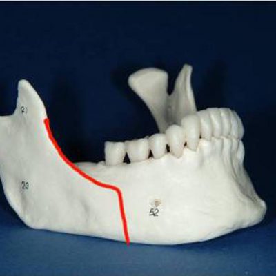 bisagital-split-osteotomy