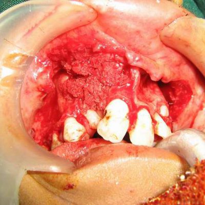 bone-graft-in-situ