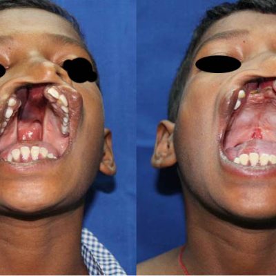 cleft palate