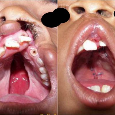 cleft palate 3