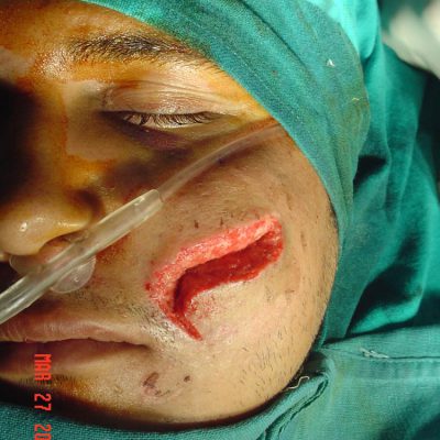 facial-lacerations