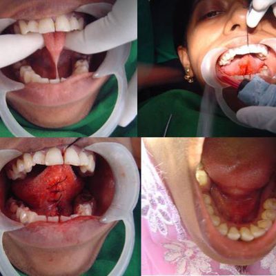 fernectomy