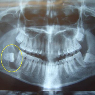 impacted-tooth-with-cyst-fromation