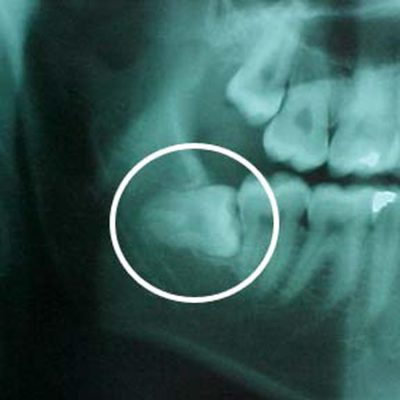 impacted-wisdom-tooth