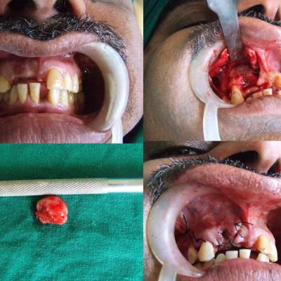 intraoral-periapical-cyst