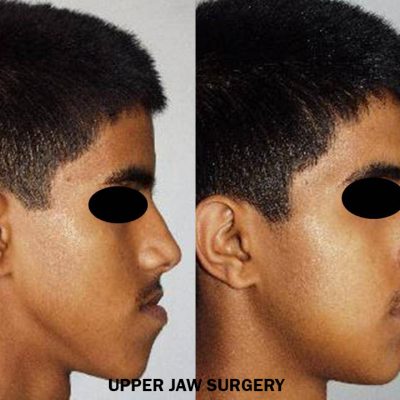 lower-jaw-set-back-surgery-