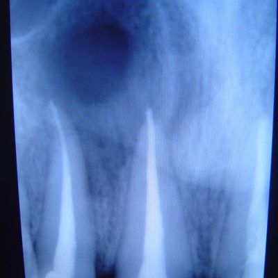 periapical-cyst-requiring-apiceotomy