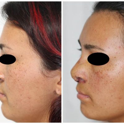 rhinoplasty post 9