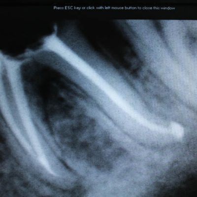 2-after-root-canal-treatment