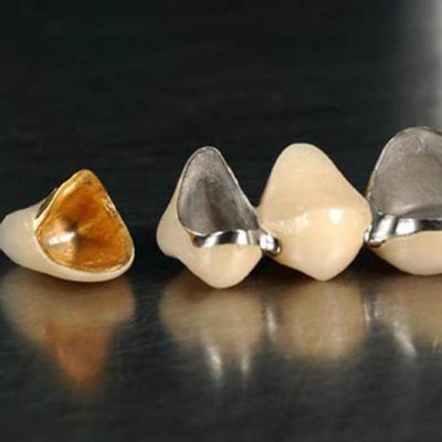 ceramic-fused-to-metal-crown-bridge