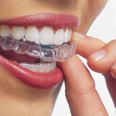 invisalign-top