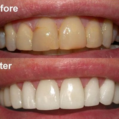 teeth-whitening