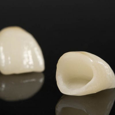 all-ceramic-anterior-crowns