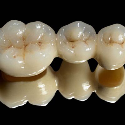 all-ceramic-bridge