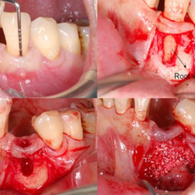 bone-grafting