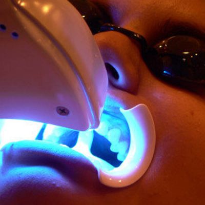 laser-teeth-whitening