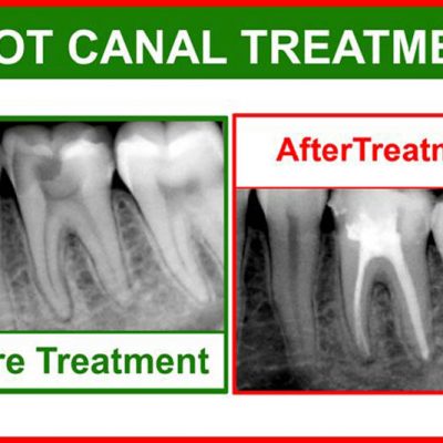 root-canal