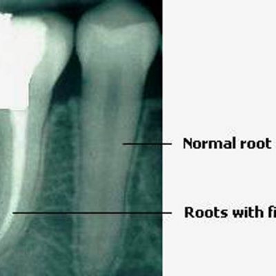 root-canal-treatment_clip_image003