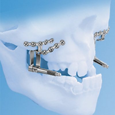 maxillary_distractor_new