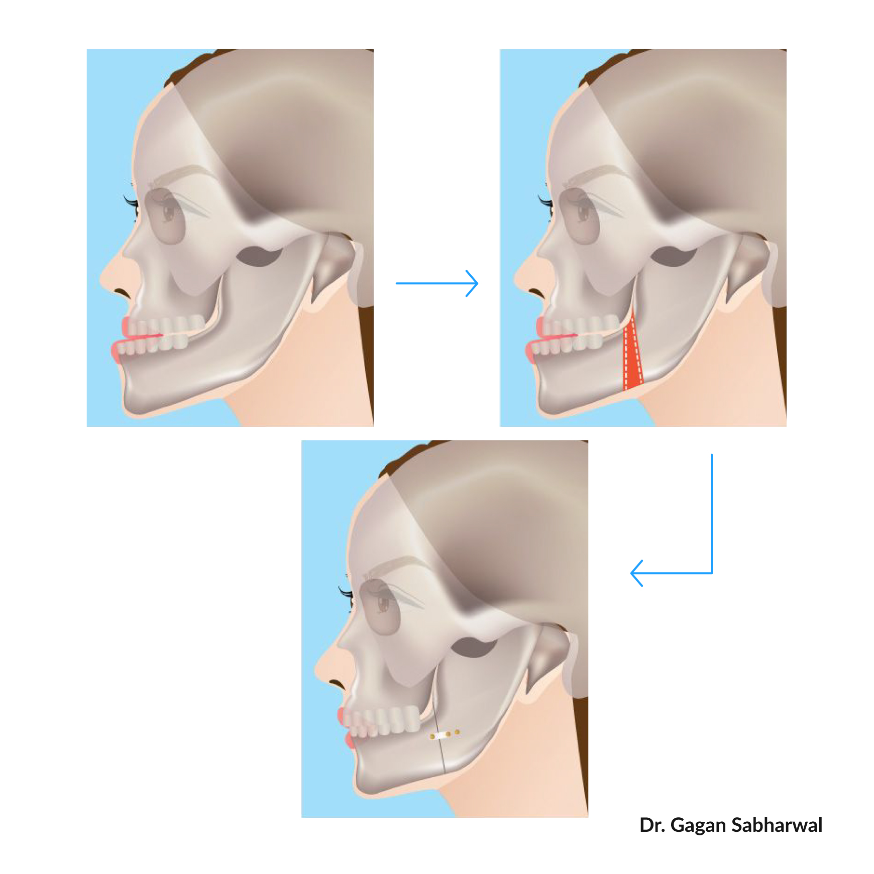 Orthognathic Jaw Surgery UAE
