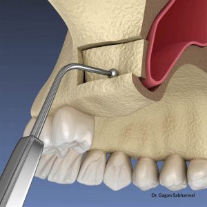  sinus lift and bone grafting surgery