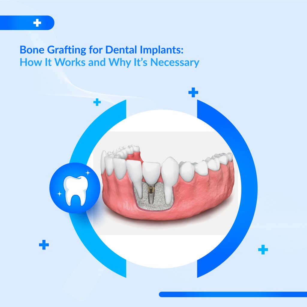 Dental Implant Specialist UAE