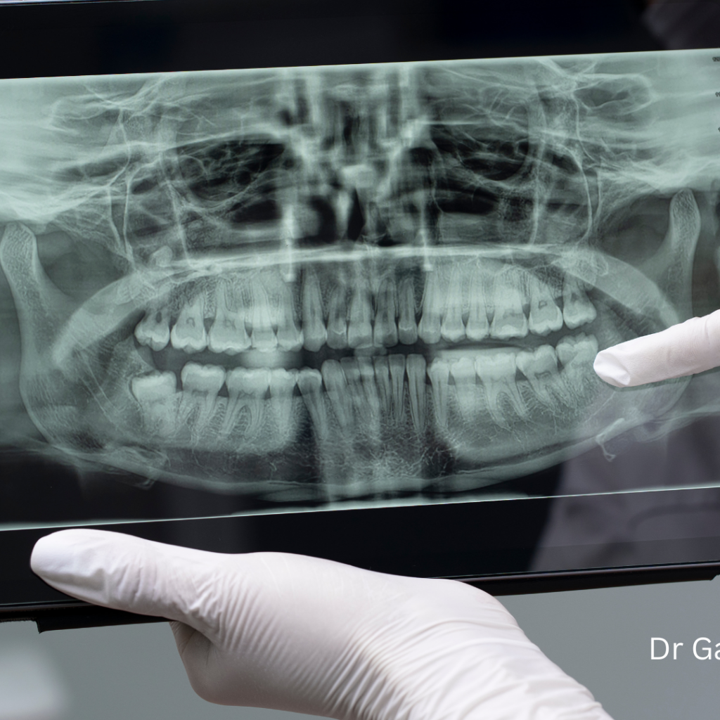 Maxillofacial Lesion Treatment UAE