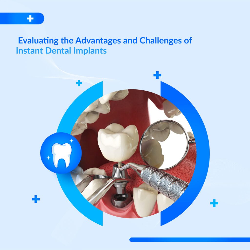 Instant dental implants