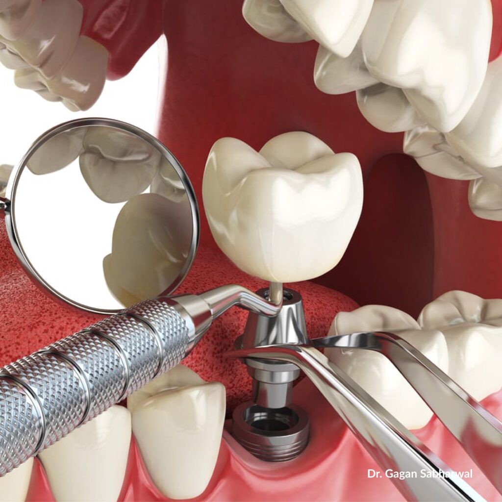 Instant dental implants