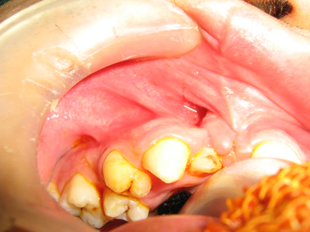 1cleft-alveolous