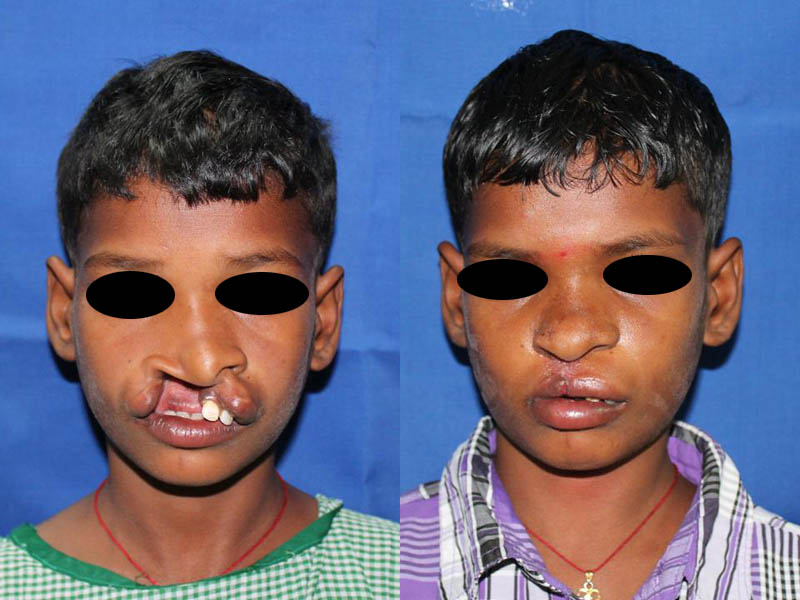 Complete-cleft-lip-3-1