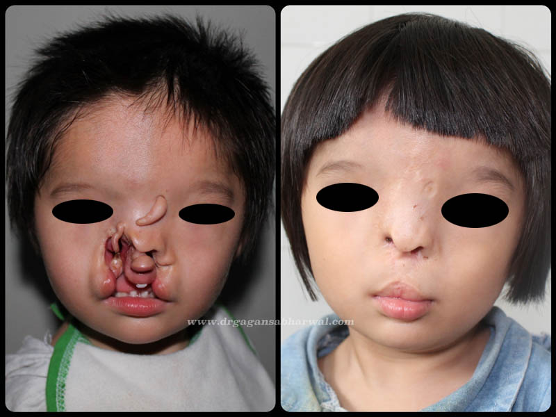 Facial-Cleft-1-1