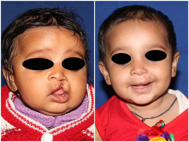 Incomplete-cleft-lip-1-2