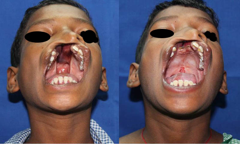 cleft-palate-1-2