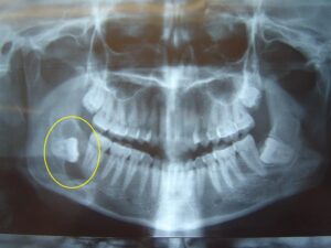 impacted-tooth-with-cyst-fromation