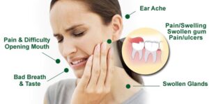 impacted-wisdom-teeth-pain-copy