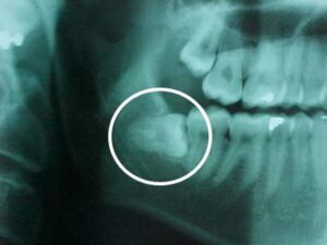 impacted-wisdom-tooth