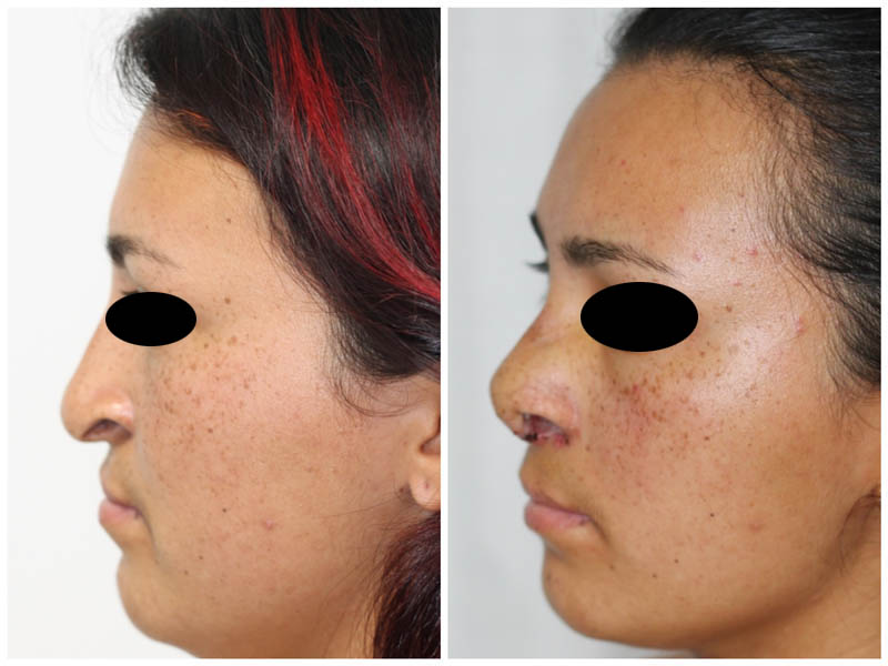 rhinoplasty-post-9-2
