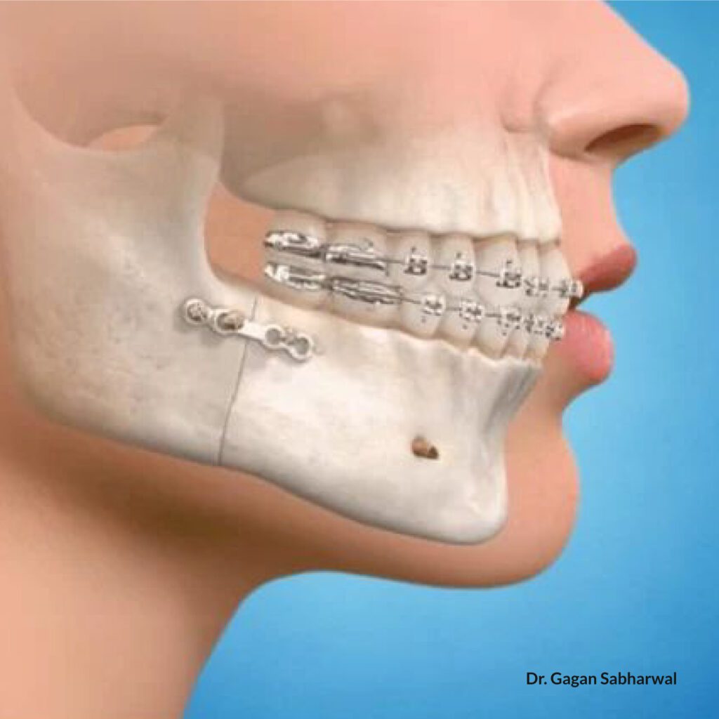 Orthognathic Jaw Surgery UAE