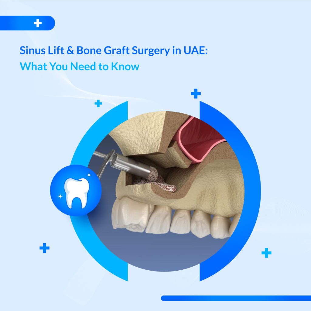 bone graft for dental implants