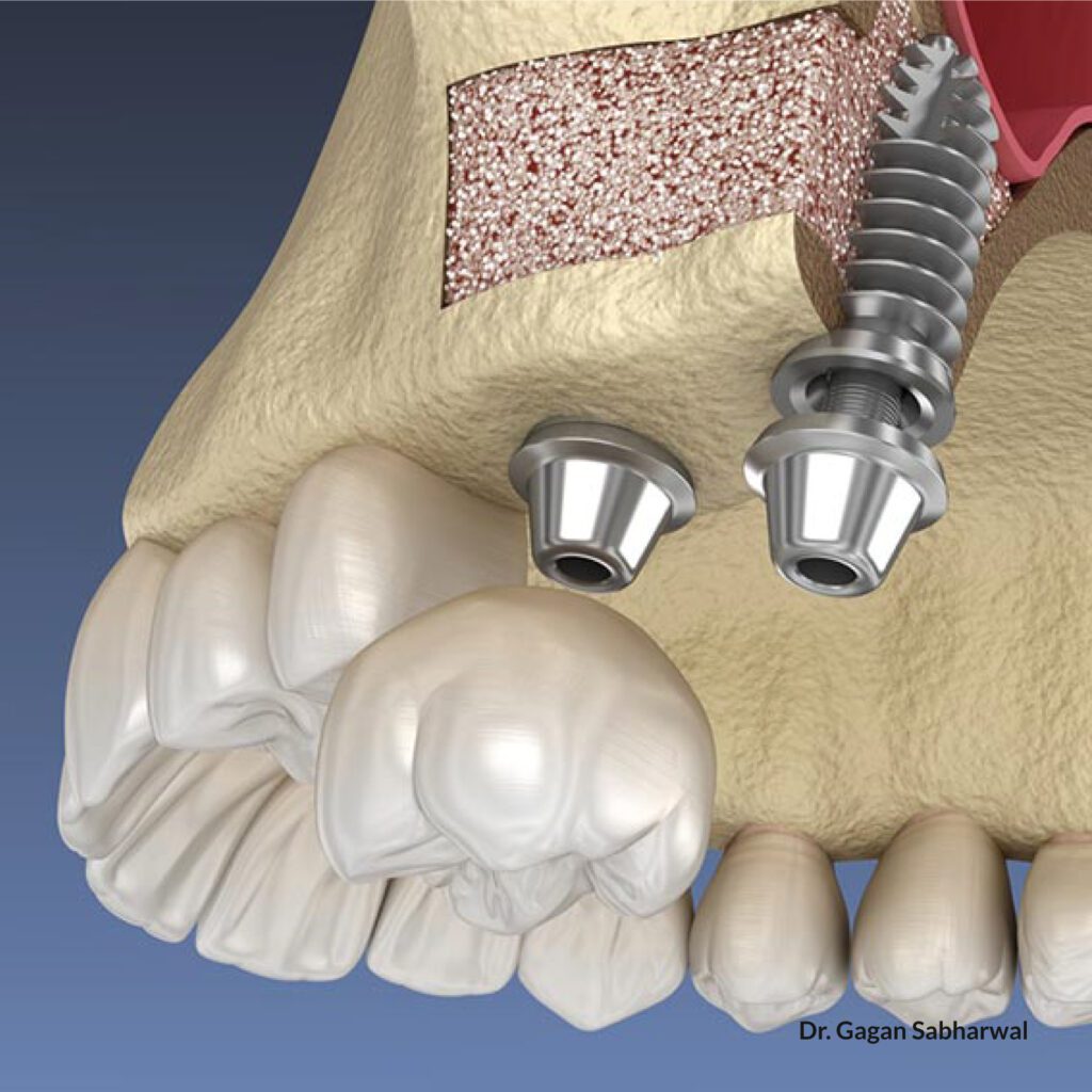 sinus lift memphis